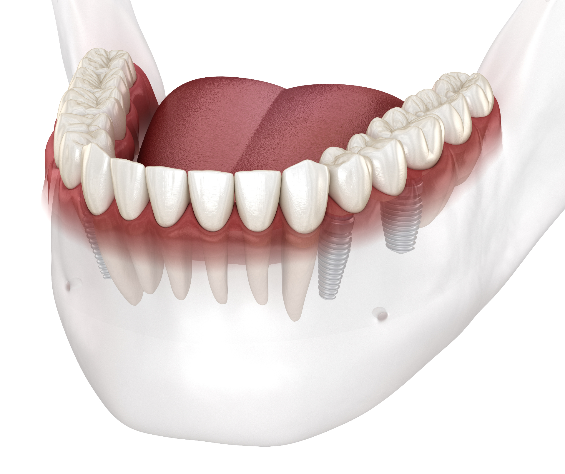 New Teeth in One Day | Needham Oral Surgery & Implant Center